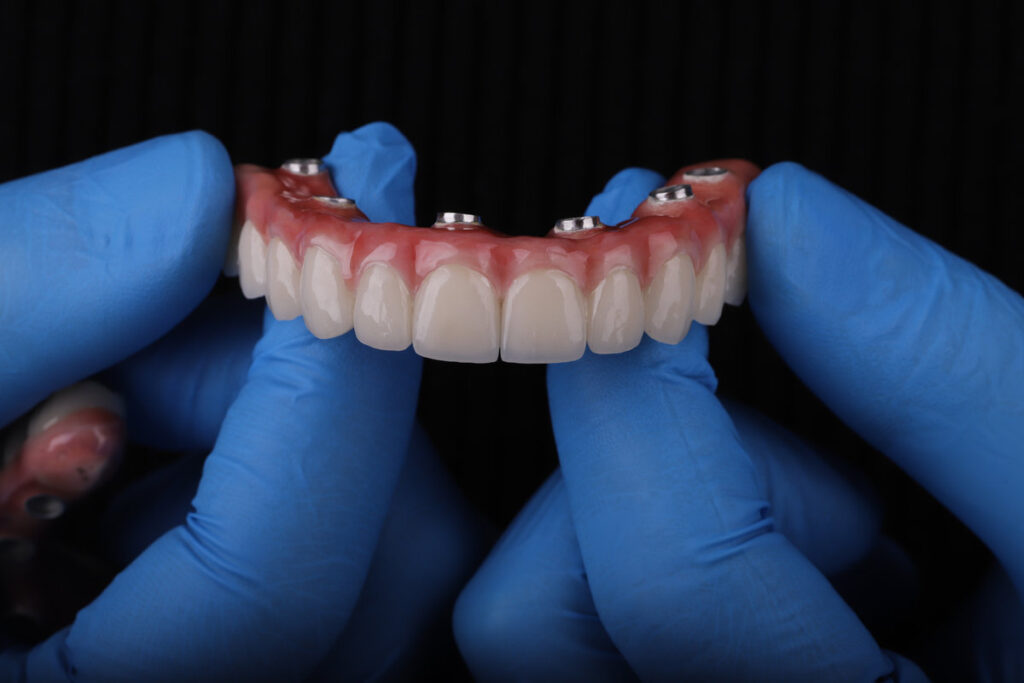 Revolutionize Your Smile with All-On-X Permanent Teeth: Stunning Photos for Adobe Stock